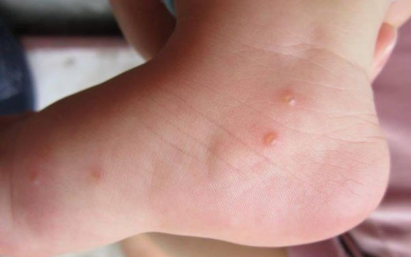 Dâu hiệu nổi ban, có bọng nước ở bé